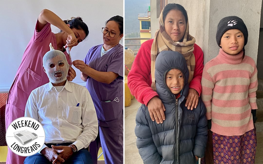Health workers participate in a training session to treat burns at the Sushma Koirala Memorial Hospital (SKMH) in Kathmandu recently (pictured, left) Photo: MARTY LOGAN Boy from Dailekh with burn injuries was brought to SKMH for treatment by his family (pictured, right). Photo: SKMH