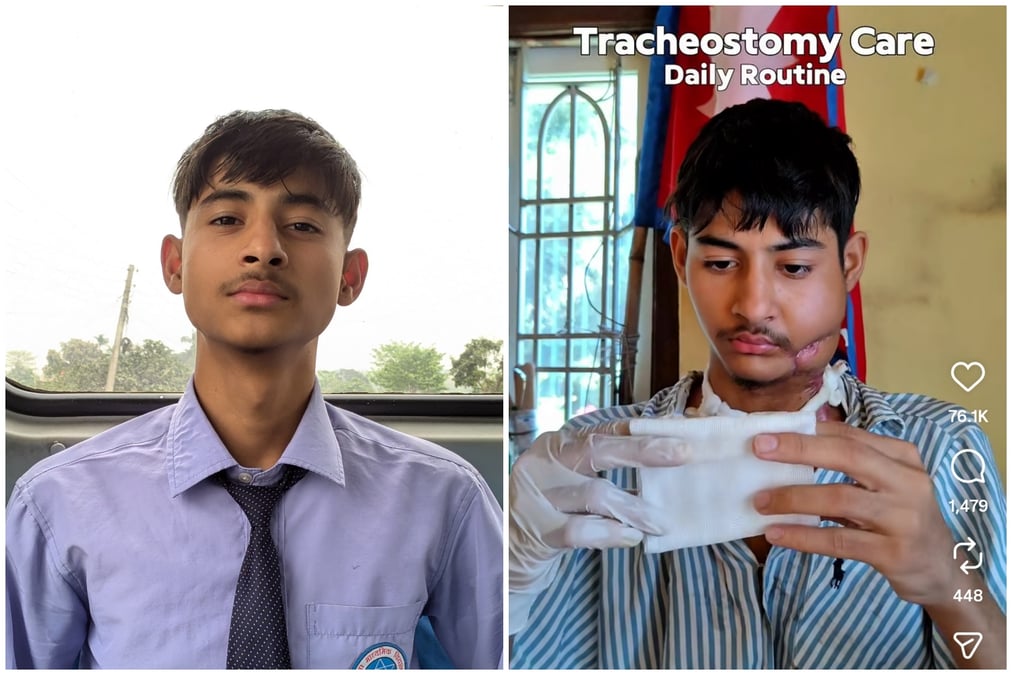 LUCKY TO BE ALIVE: Shantanu Dhakal (left) before he was shot in the face during the GenZ protest on 8 September and in a social media post documenting his recovery (right).